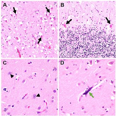 Neuropathological findings in COVID-19 vs. non-COVID-19 acute respiratory distress syndrome—A case-control study